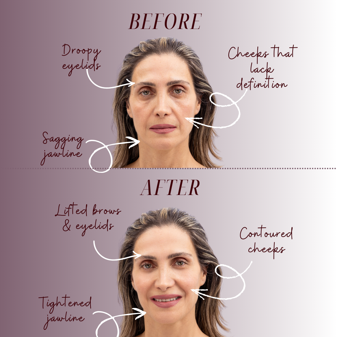 Gleam MicroLift Device